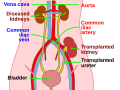 Kidney transplant