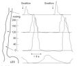 Esophageal motility study