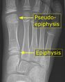 First metatarsal bone