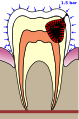Barodontalgia