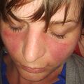Pemphigus erythematosus