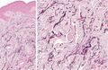 Histopathology of linear focal elastosis