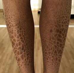 Ichthyosis