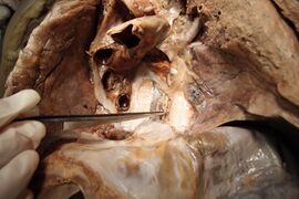 Front photo of the Ductus Thoracicus in the Human mediastinum with the heart and part of the pericard removed.