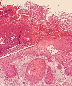 Ulcer border of a squamous cell skin cancer