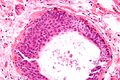 Walthard cell rest - very high magnification