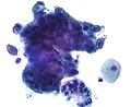 Adenocarcinoma cells on a Pap test