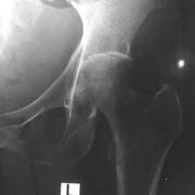 Septic arthritis of left hip joint with melioidosis