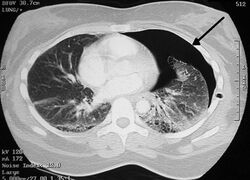 Pneumothorax CT