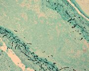 Meningitis fungus in brain