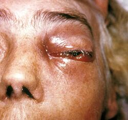 Periorbital fungal infection known as mucormycosis, or phycomycosis