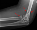 Radial head fracture