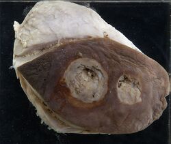 Tuberculous cold abscess with sinuses