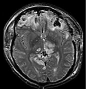 Brain injury