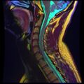 Disc herniation