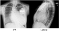 CRT in dilated cardiomyopathy and mitral valve replacement