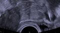 Perforated IUD