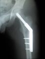 Dynamic hip implant