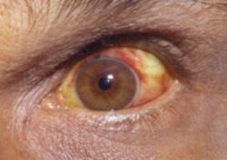 Conjunctival suffusion of the eyes due to leptospirosis