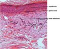 Micrograph of solar elastosis
