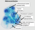Pap stain of adenocarcinoma in peritoneal fluid