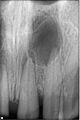 Periapical radiolucency