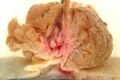 Villous adenoma of the sigmoid colon, gross pathology