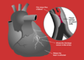 Left anterior descending artery
