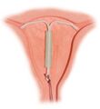 Hormonal intrauterine device