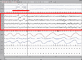 Sleep EEG REM