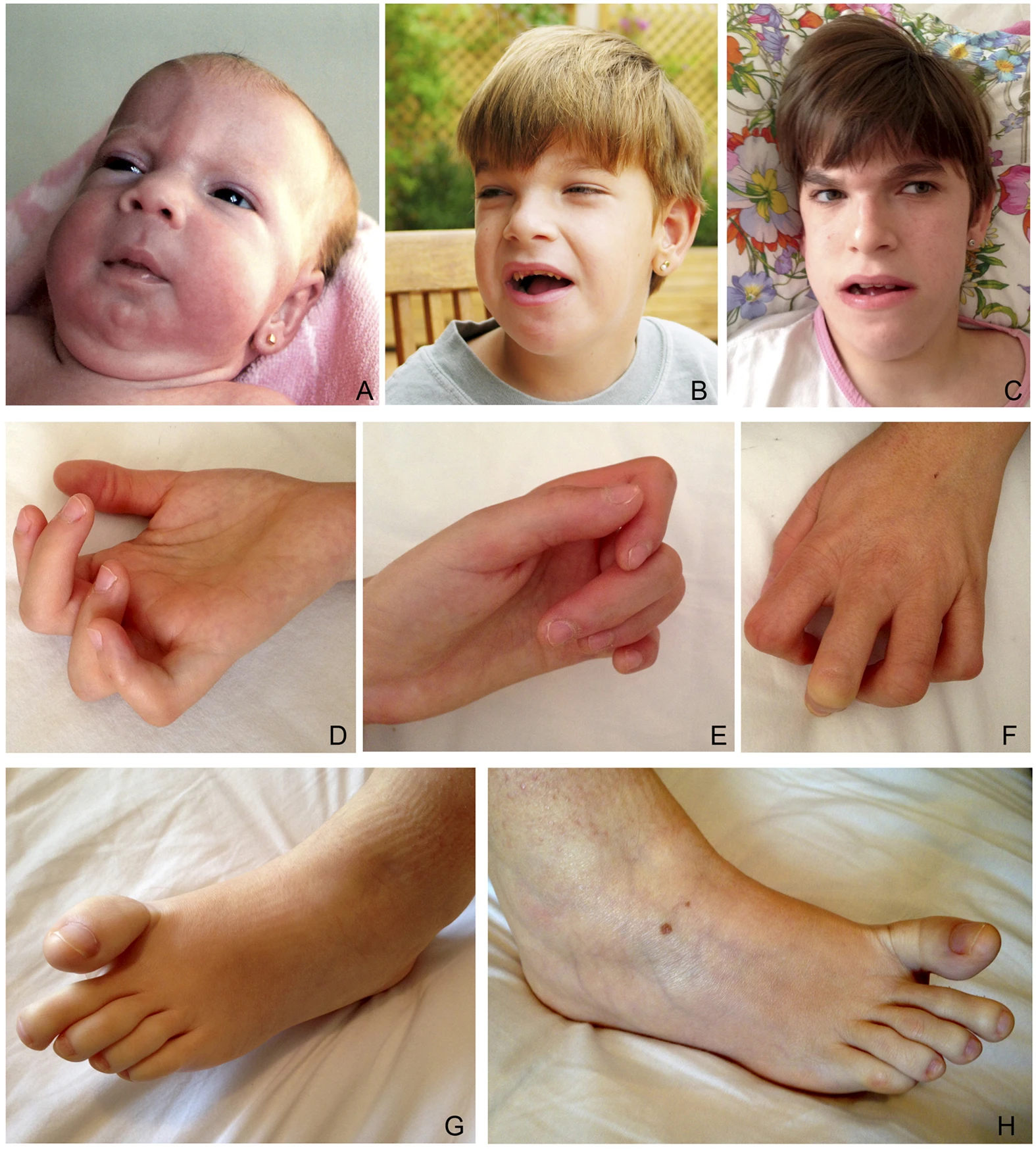 Person with Schaaf-Yang syndrome