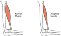 Muscle Atrophy