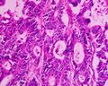 Adenocarcinoma recti (moderate differentiaded)