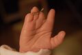 Amniotic band hand
