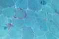 Muscle biopsy