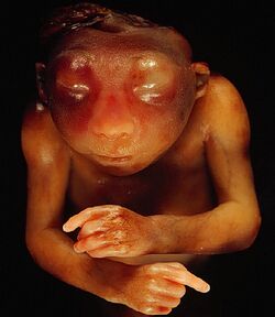 Spina bifida with anencephaly