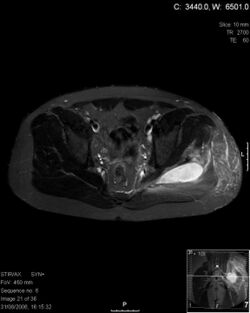Pyomyositis MRI