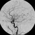 Cerebral Angiogram Lateral