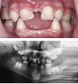 Dental abnormalities in a 5-year-old girl with hypohidrotic ectodermal dysplasia