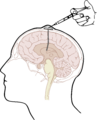Ommaya reservoir used for intracerebroventricular injection