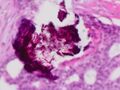 Histopathology of dystrophic microcalcifications in ductal carcinoma in situ