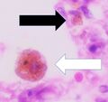 Histopathology of siderophage in chronic pulmonary congestion