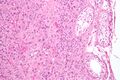 Leydig cell tumour