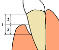 Diagram showing periodontal terms and gingival recession