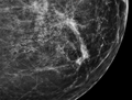 Microcalcification
