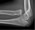 X-ray of ventral dislocation of the radial head with calcification of annular ligament