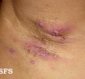 Hidradenitis