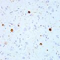 Dementia with Lewy bodies