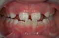 Enamel hypoplasia