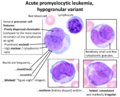 Peripheral blood smear of acute promyelocytic leukemia, hypogranular variant